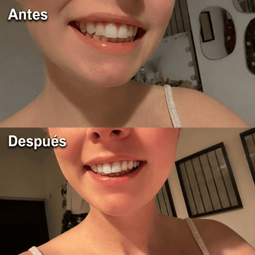 Dentz™ | Lápiz Sérum Blanqueador Dental ¡Redescubre Tu Sonrisa!