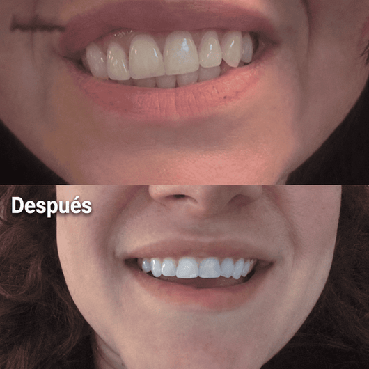Dentz™ | Lápiz Sérum Blanqueador Dental ¡Redescubre Tu Sonrisa!