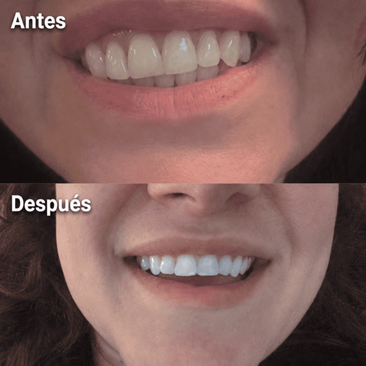 Dentz™ | Lápiz Sérum Blanqueador Dental ¡Redescubre Tu Sonrisa!